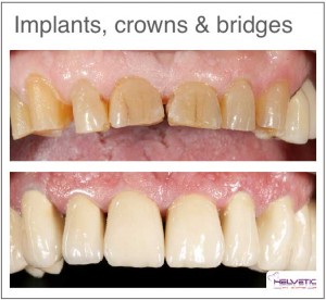 Dental implant price Helvetic Clinics