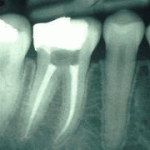 root-canal-treatment2